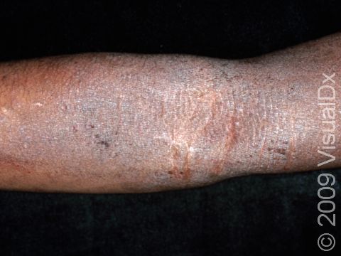 Atopic dermatitis (eczema) typically involves the folds of the elbows and knees. When longstanding, the skin can be very thickened (lichenified) from chronic scratching.