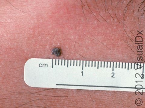 This image displays an atypical nevus (mole).