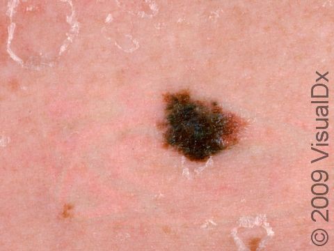 This image displays an atypical nevus (mole) that is larger than a pencil eraser in diameter, has an irregular border, and has a slightly lighter pink-brown color on the right side, in addition to peeling skin from a sunburn.