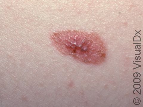 This image displays an atypical nevus, an unusual mole that is often larger than a pencil eraser and has variation in color and shape.