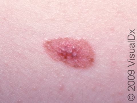 This image displays an atypical nevus, an unusual mole that is often larger than a pencil eraser and has variation in color and shape.