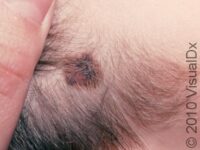 Mole, Atypical (Atypical Nevus)