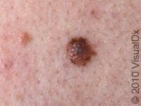 Mole, Atypical (Atypical Nevus) – Adult