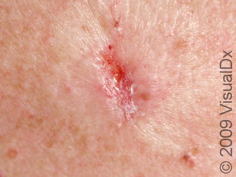 The infiltrating type of basal cell carcinoma can appear as a scar or resemble a superficial skin ulcer. These skin cancers often fool patients because they appear small.