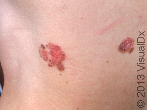 This image displays multiple basal cell carcinoma.