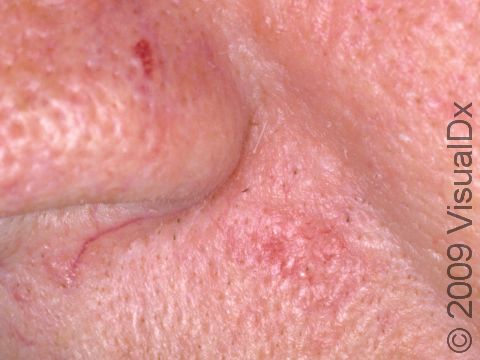 Basal cell skin cancers can be subtle. Just to the right of the nose and slightly below there is some redness and fine blood vessels. This is an early basal cell skin cancer.