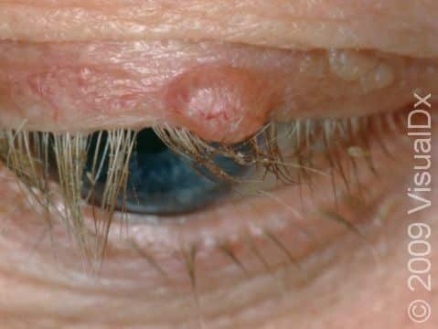 This image displays a smooth lesion with small blood vessels on the surface typical of basal cell carcinoma.