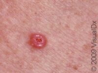Skin Cancer and Moles