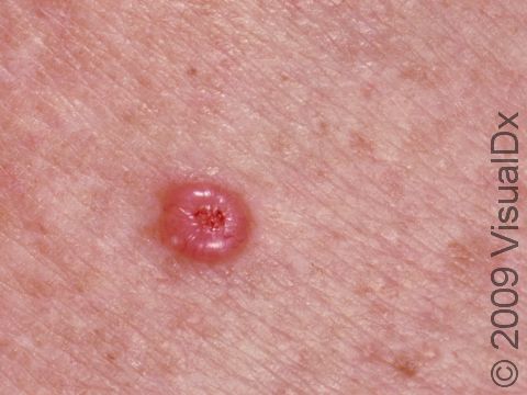 Basal cell carcinoma typically has a rounded border with a central depression and a small crust due to bleeding.