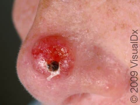 Basal cell carcinomas can be red due to the presence of many blood vessels, as displayed in this image.