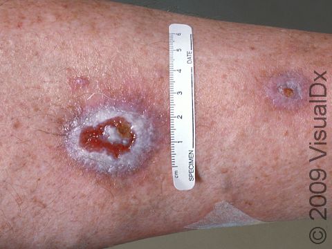 Basal cell carcinoma can look like an ulcer.