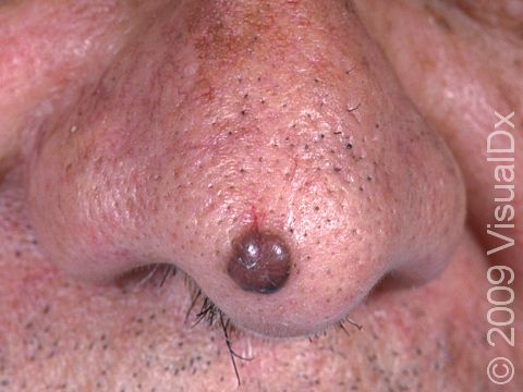 Basal cell skin cancers often have a shiny appearance with noticeable small blood vessels.