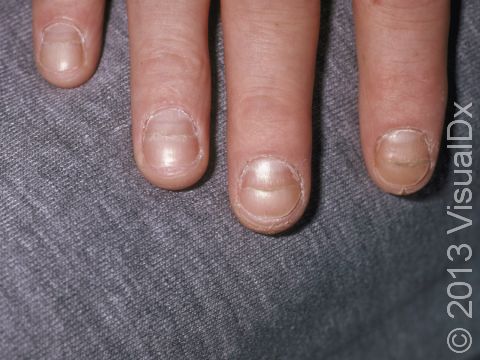 Beau's lines (crosswise nail plate grooves) are due to severe illness or certain medications.
