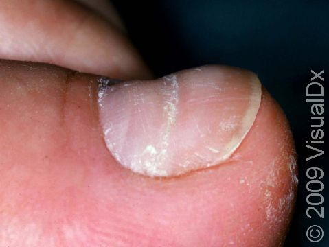 How to Remove White Spots on the Toenails - Paola Ponce Nails