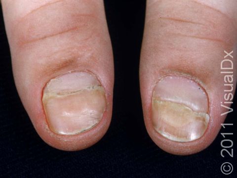 Beau's lines in multiple fingernails (typically all of them) are usually due to a recent illness. This patient had a severe bout of the flu several months previously.