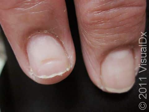 A Beau line in a single fingernail is usually a sign of trauma that occurred only to the affected digit.