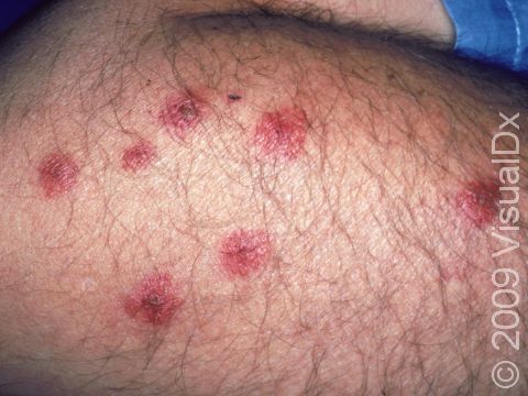 Bedbug bites can have a central darker area within the red circle of inflammation.