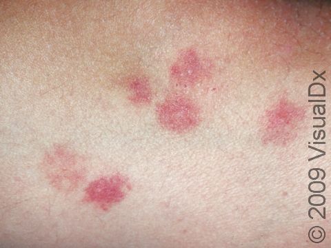 Bedbug bites are often clustered near each other on the skin.