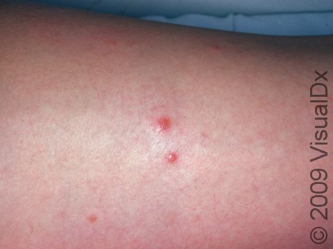 Bedbugs can cause small, red, itchy bumps.