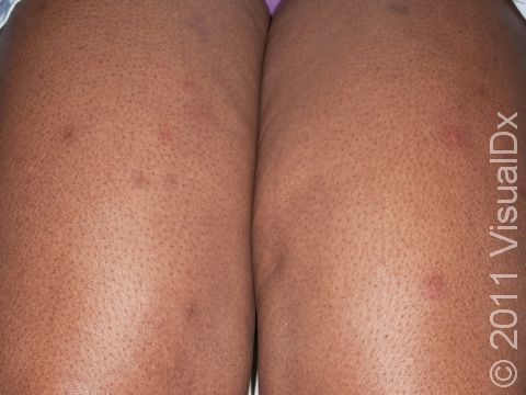 Bedbug bites on dark skin.