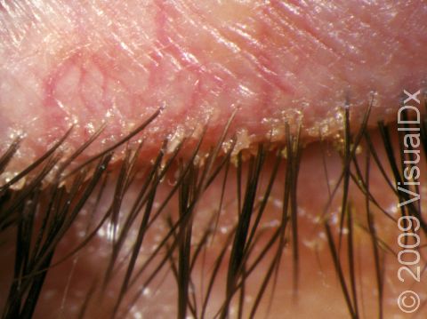 The crusty, grainy, or scaly appearance at the base of the eyelashes is the most common finding in blepharitis.
