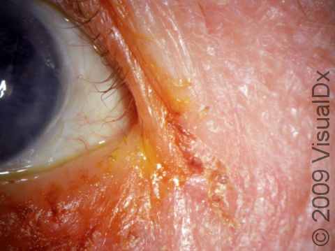 This is the classic appearance of blepharitis involving the outer angle of the eyelid, called angular blepharitis.