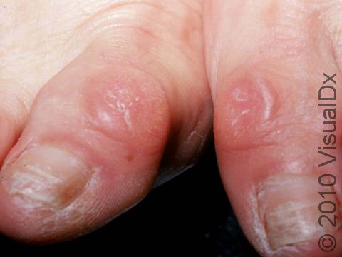 This image displays callouses at the tops of both great toes as well as toenail changes from repeated pressure.