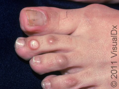 Calluses on the tops of the toes are often due to ill-fitting shoes.