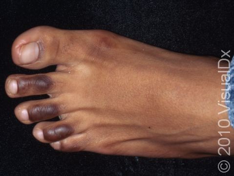 This image displays callus areas of the upper toes, which are darker in this Black patient.
