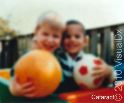 Blurry vision, including the dulling of colors, is a classic finding in cataract.
