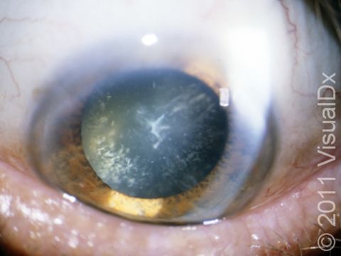 This image shows cataracts that are seen as white specks on the eye. 