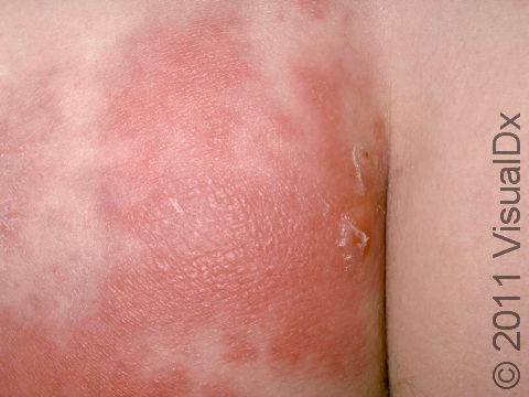This image displays cellulitis on the buttock.