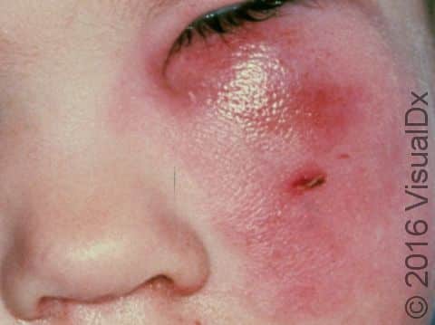 The common features in cellulitis, a skin and soft tissue infection, are redness, warmth, and swelling of the infected skin.