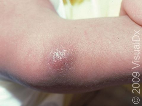 This image displays an infant with early cellulitis.