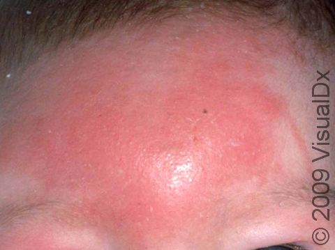This child had redness, swelling, and warmth of the skin of the forehead typical of cellulitis.