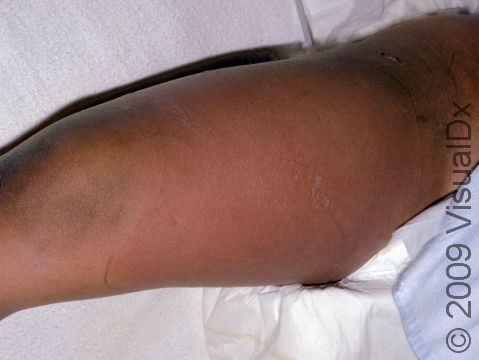 This image displays a red, swollen, tender leg typical of cellulitis, a bacterial skin and soft tissue infection.