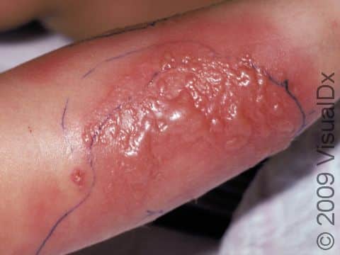 The outline in pen was drawn when the patient presented to the emergency room. Within a day the skin infection had enlarged and blisters (bullae) had formed. Cellulitis is a serious infection requiring intravenous antibiotics.