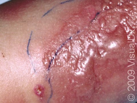 This image displays tense blisters typical of cellulitis.