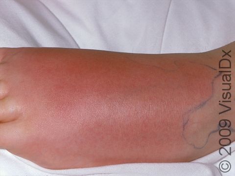 Cellulitis Condition, Treatments and Pictures for Adults - Skinsight