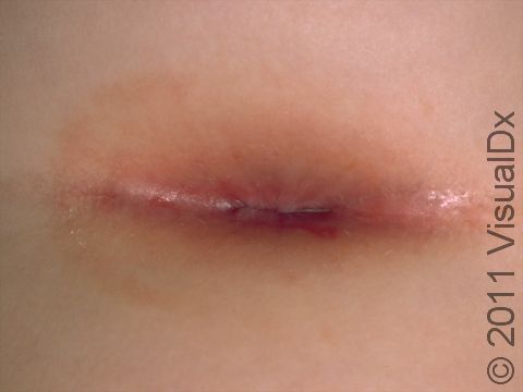 Perianal redness may be due to strep bacteria causing cellulitis.