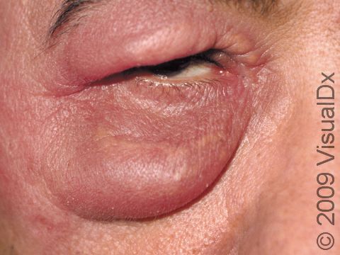 Severe redness and swelling are typical in cellulitis. The skin is usually very warm to the touch.