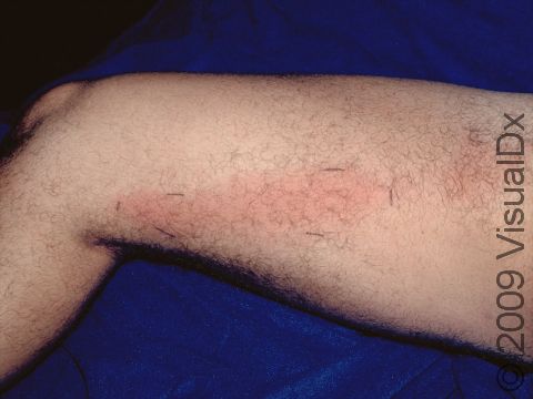 Red streaking may indicate that the infection is spreading.