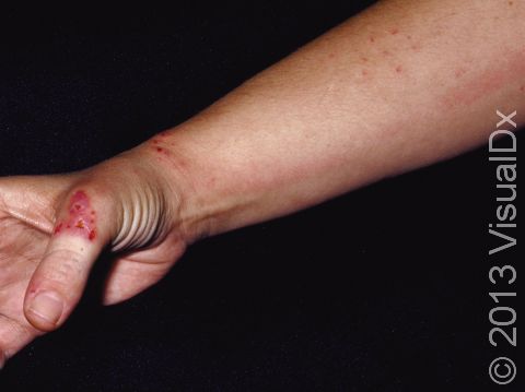 The original superficial skin infection on the thumb is now complicated by deeper tissue infection (cellulitis). Note the red streak going up the arm due to bacterial infection.