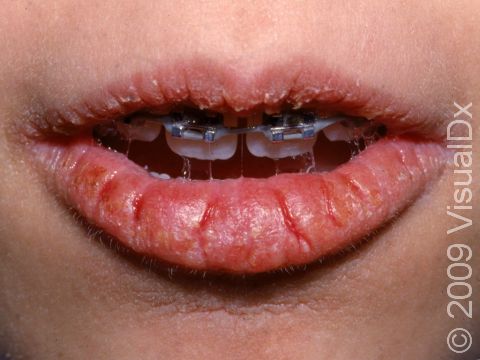 This image displays red, swollen, cracked lips and irritation of the mouth corners typical of cheilitis, due to repeatedly licking the lips.