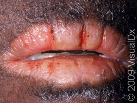 Cheilitis (inflammation of the lips) can cause scaling and severe cracking or fissuring of the lips, as displayed in this image.