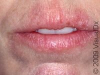 Chapped Lips (Cheilitis)