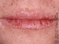 Chapped Lips (Cheilitis) – Adult
