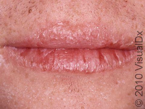 Chapped lips are inflamed, scaly, and cracked. The border of the lips is often obscured by the inflammation, as on the upper lip here.