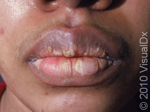This image displays scaling and thickening of the lips typical of cheilitis.