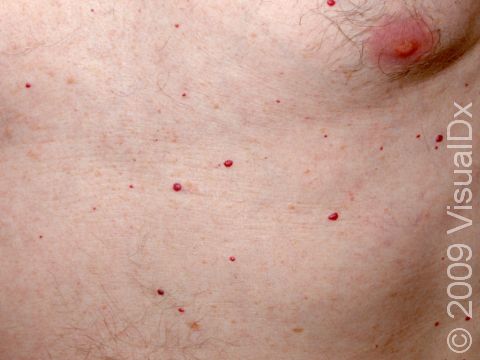 The small, red bumps of cherry hemangiomas can be widespread and vary in size, as in this adult. As a general rule, cherry hemangiomas do not become much larger than an eraser on a pencil.